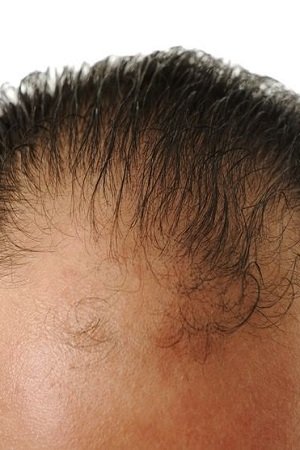 Non surgical male hair loss solutions in Birmingham