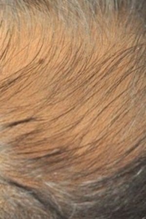 THINNING HAIR SOLUTIONS at HOUSE OF HAIR REPLACEMENT BIRMINGHAM Copy