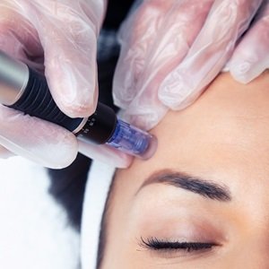  MICRONEEDLING at house of hair replacement in Birmingham