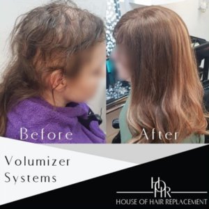 volumizer systems at house of hair replacement birmingham