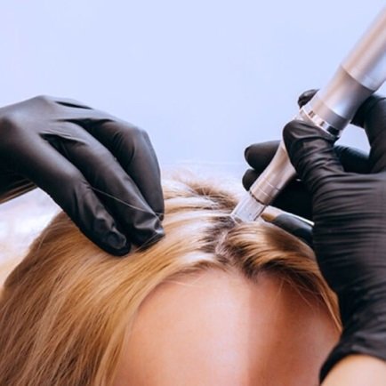 scalp microneedling in Birmingham for hair loss