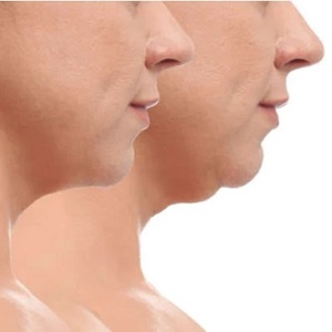 fat loss injections in Birmingham fat loss injections in Birmingham