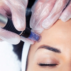 MICRONEEDLING at house of hair replacement in Birmingham MICRONEEDLING at house of hair replacement in Birmingham