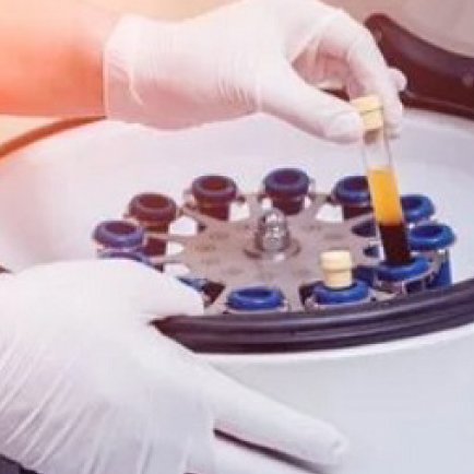 HAIR GROWTH WITH PLATELET RICH PLASMA HAIR GROWTH WITH PLATELET RICH PLASMA