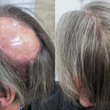 HAIR REPLACEMENT SYSTEMS FOR MEN