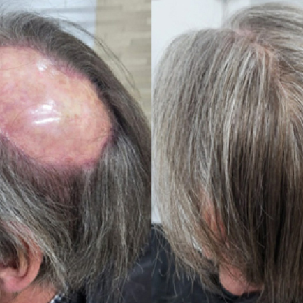 HAIR REPLACEMENT SYSTEMS FOR MEN HAIR REPLACEMENT SYSTEMS FOR MEN