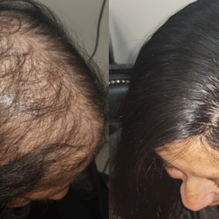 HAIR SYSTEMS FOR WOMEN HAIR SYSTEMS FOR WOMEN