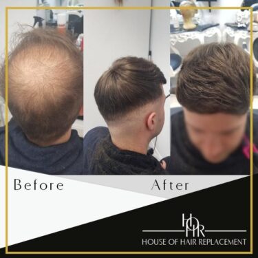 Men's Hair Replacement Training