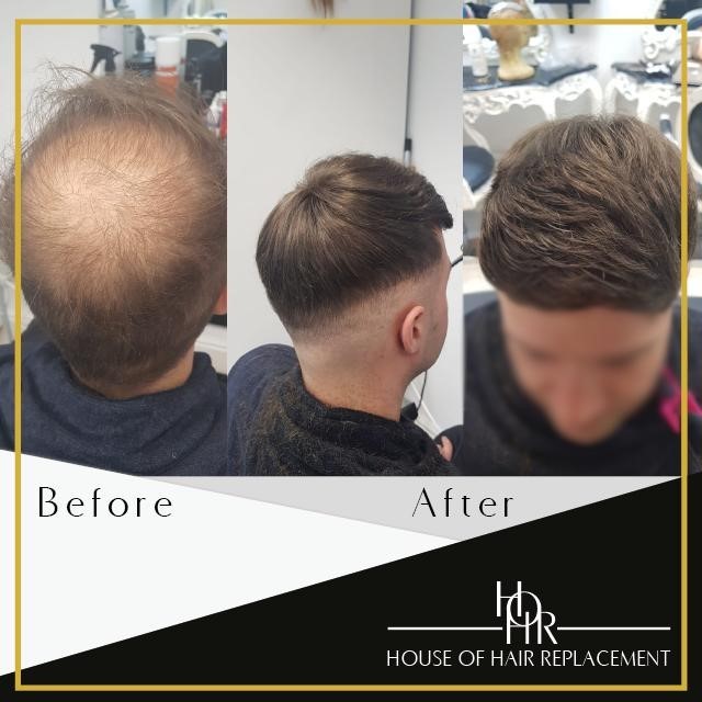 Men's Hair Replacement Training Men's Hair Replacement Training