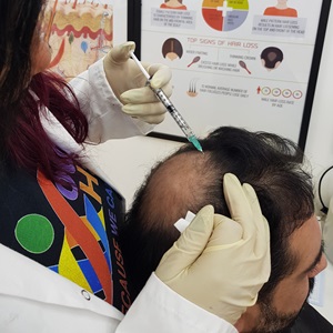  mesotherapy hair loss treatments at house of hair replacement in Birmingham